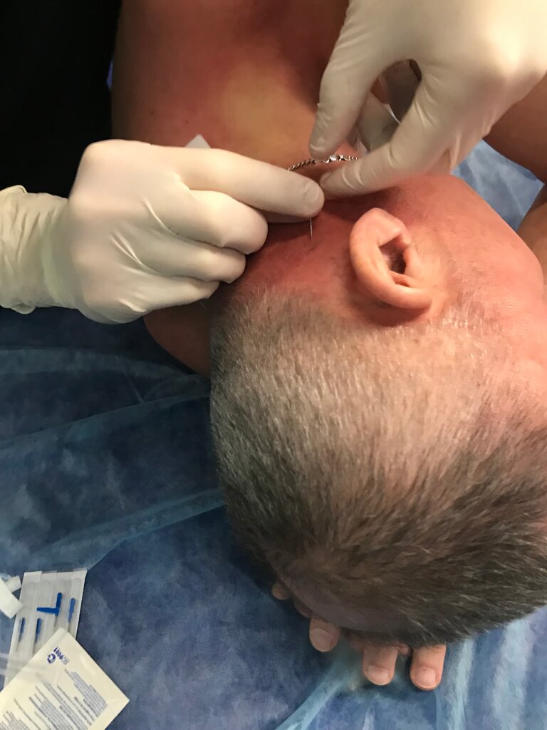 Метод лечения Китайским Иглоножом