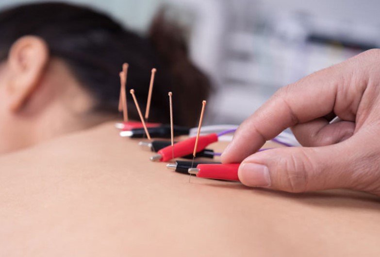 «Сухое» иглоукалывание (Dry Needling)